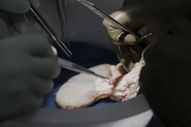 紐約大學的外科醫生將豬腎移植到一名腦死亡的人體內，一個多月以來，它一直正常工作。AP