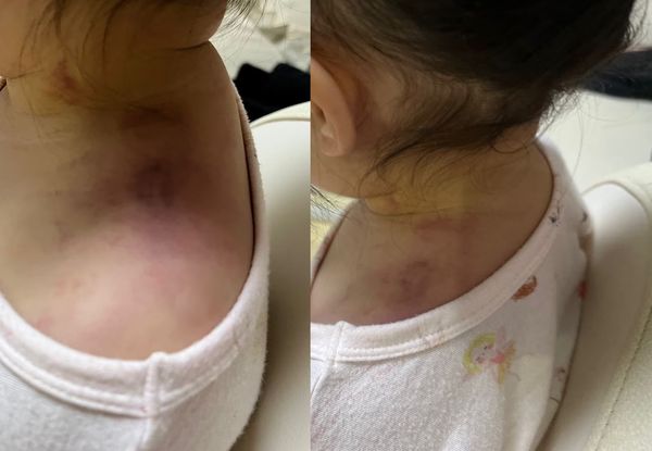 南韓2歲女童在幼兒園遭到教師不當管教、虐待，肩膀出現嚴重瘀傷。  