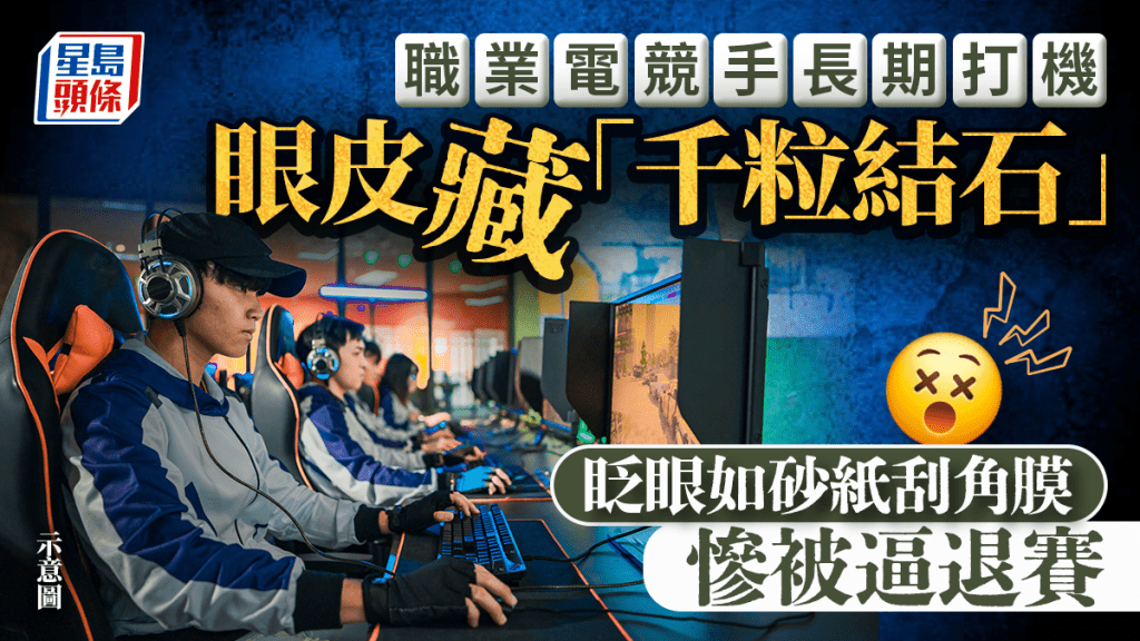 台電競手眼皮塞滿近千顆眼結石 眨眼如「砂紙」直刮角膜