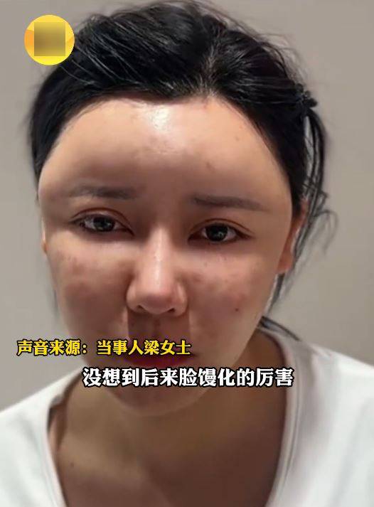 湖北的梁女士因在臉部注射生長因子變成面具人。起點新聞