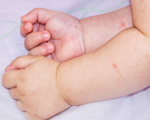 小兒濕疹又稱異位性皮炎，主要成因分為內在及環境。