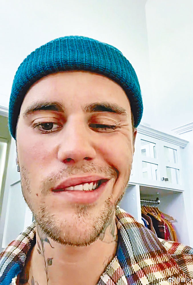 Justin因患罕見病導致右邊面面癱。