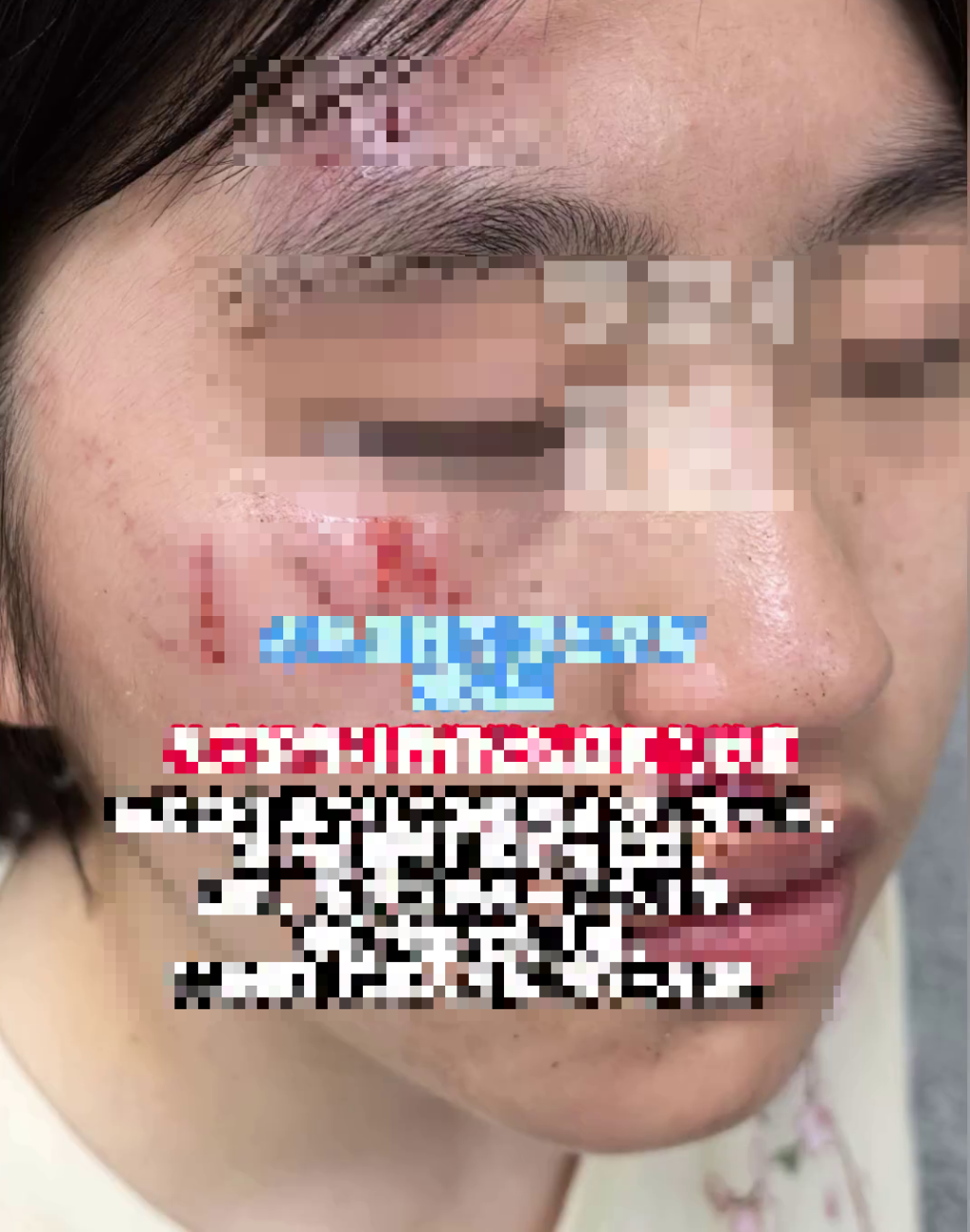少女被打后血流披脸，伤痕累累。