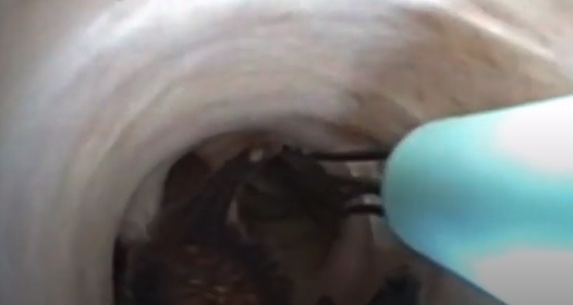 夾出寄生蟲(圖片來源:新英格蘭醫學期刊)