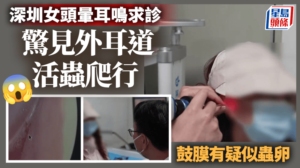 活蟲耳朵起巢,深圳女子頭暈耳鳴竟是耳內有蟲。