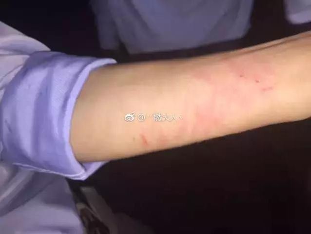 疑似事主上載被抓傷照。