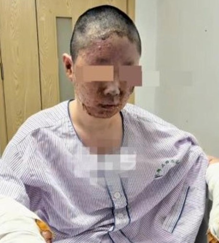 童瑤受傷嚴重。 童瑤受傷嚴重。