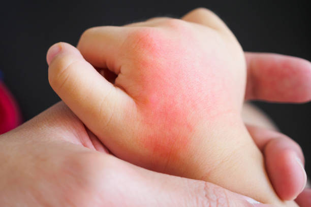 小朋友忍不住抓傷皮膚，更有機會出現細菌感染，令濕疹惡化。