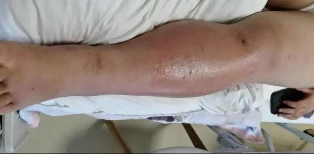 方女士左小腿腫脹明顯,蚊子叮咬處的那個紅疙瘩出現破潰,