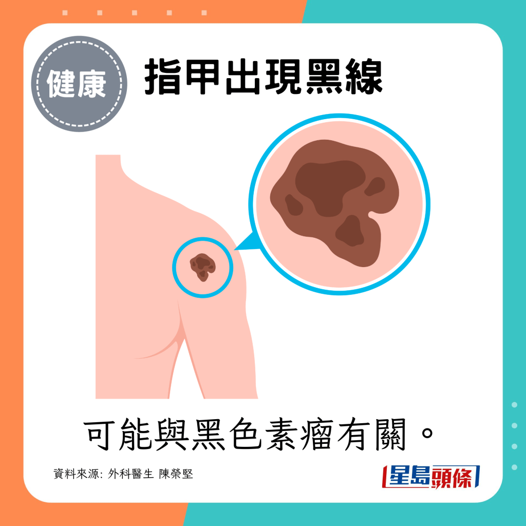 可能與黑色素瘤有關。