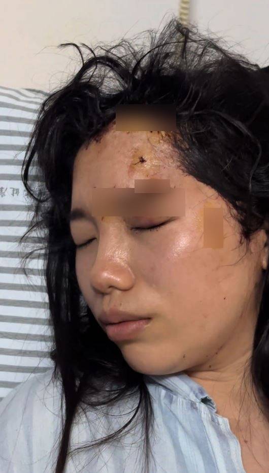 陳小姐被男同事掟杯襲擊,導致臉部重創要縫逾20針毀容。抖音 陳小姐被男同事掟杯襲擊,導致臉部重創要縫逾20針毀容。抖音