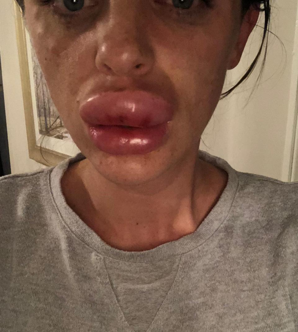 女子注射肉毒杆菌（Botox）及填充物后出现不适。网上图片