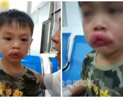 男童進食葡萄後過敏腫成性感「嘟嘟嘴」。網圖