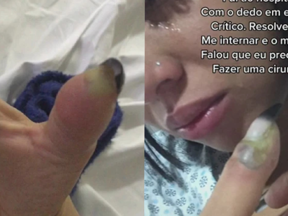 女子的拇指在美甲后流脓和发黑。 （网上图片）