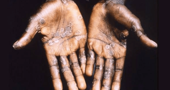 猴痘是一种病毒性传染病，主要集中在中非或西非国家。网上图片