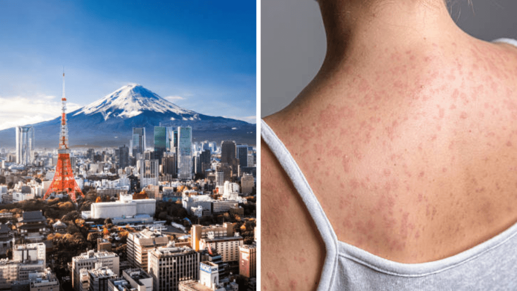 遊日注意｜日本麻疹感染升溫 東京現今年首病例 傳染性高恐致「免疫失憶」更易患肺炎