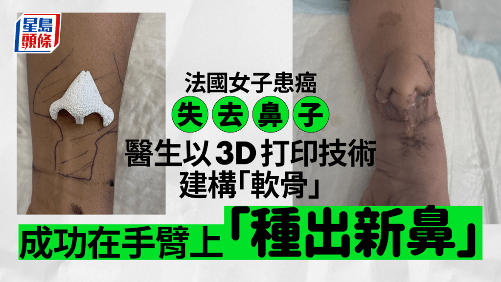 法國婦女因癌症失去鼻子，靠3D打印「手臂種出新鼻」。