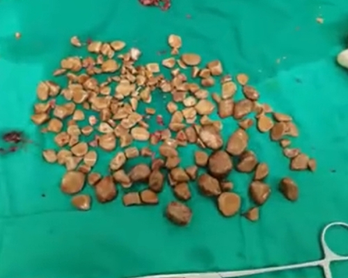 醫生在男子膀胱取出近200粒結石。網上圖片