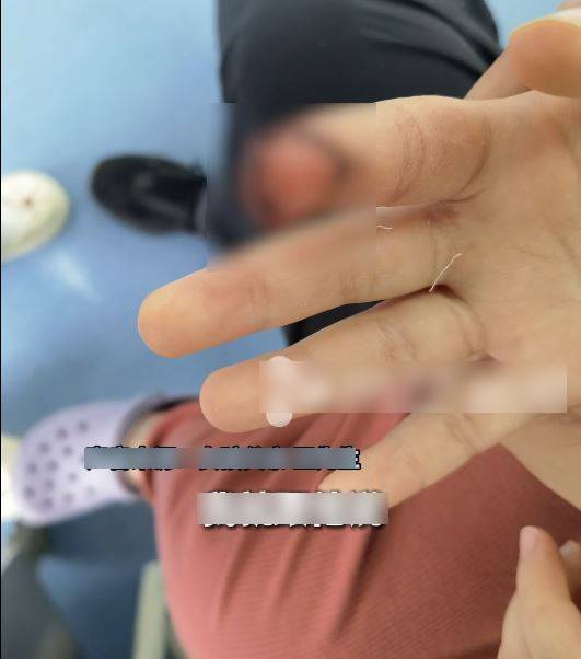 女童右手食指被馬匹咬傷。風芒新聞