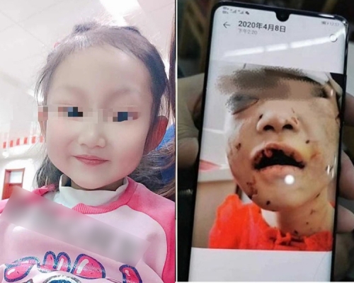 黑龙江被生父继母虐打4岁女童已苏醒能进食。(网图)