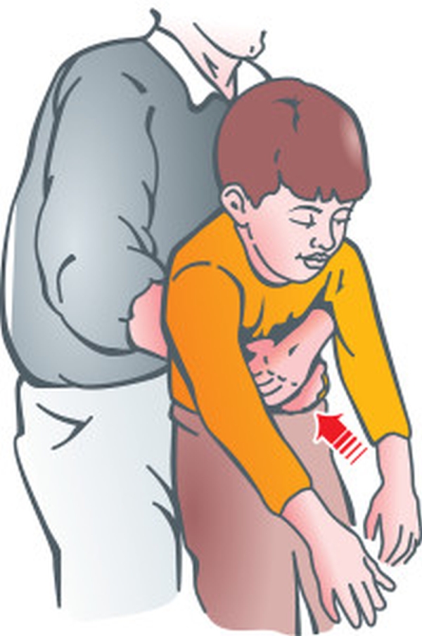 哈姆立克急救法(Heimlich Maneuver)在全世界被廣泛應用(如圖所示),靠著這個擁抱拯救了無數患者,因此該法被人們稱為「生命的擁抱」。(網圖)
