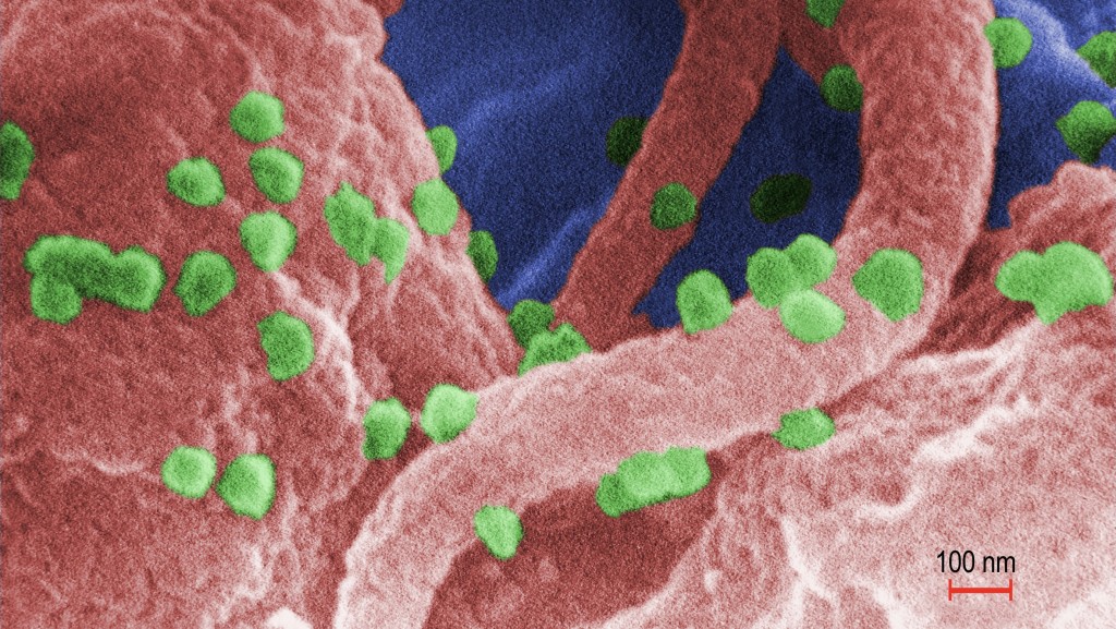 美国疾控中心取得的电子显微镜影像显示，大量HIV-1病毒体（图中球状物）从培养的人类淋巴球中发芽。 路透社