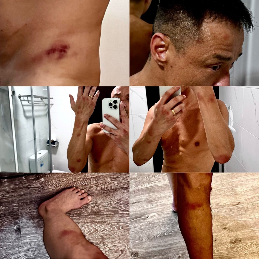 王喜曾在IG貼上不少滿身傷痕的相片。 王喜曾在IG貼上不少滿身傷痕的相片。