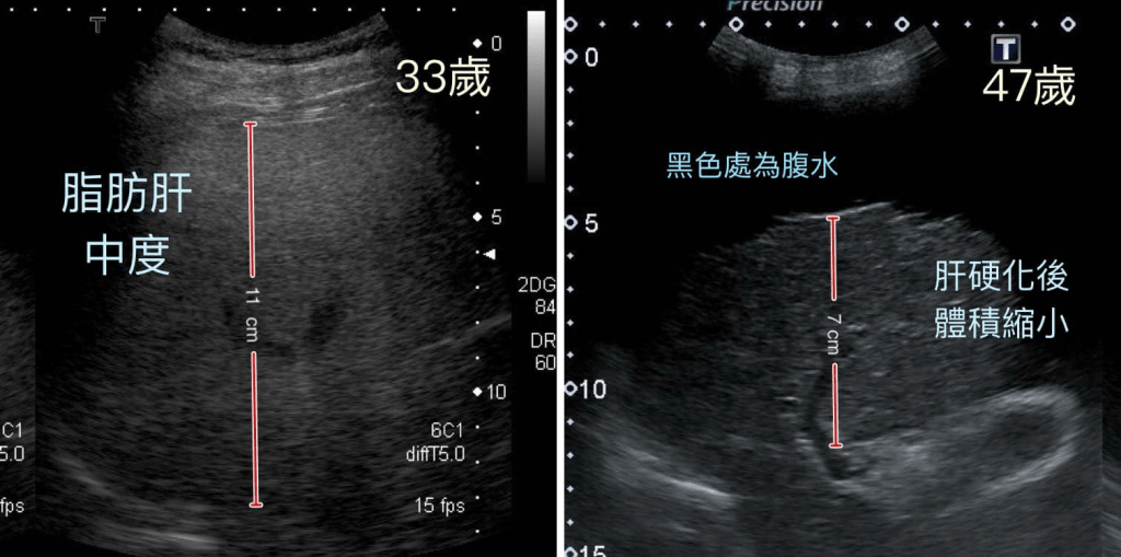 该男子14年前的检查映像（左）显示当时33岁的他患有中度脂肪肝；1年前因吐血紧急送院，脂肪肝已在14年间急速恶化成肝硬化。（图片来源：胃肠肝胆科医生钱政弘Facebook）