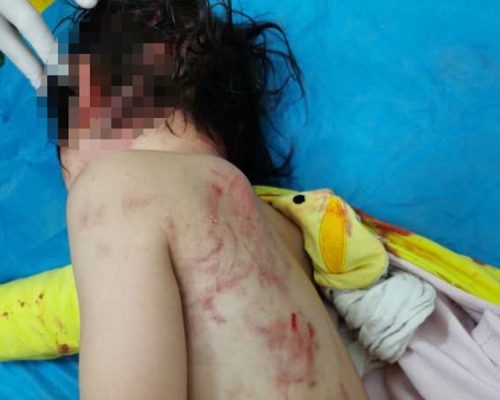 女童遍體鱗傷。網圖