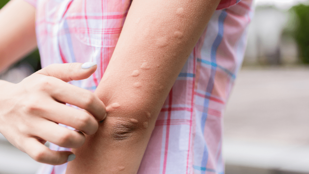 皮膚科專科醫生陳厚毅提醒市民，床蝨的叮咬痕跡與蚊蟲不同，前者患處會有較密集且較細的紅腫，後者則會有一兩個比較大的紅腫。圖為蚊子叮咬痕跡。iStock示意圖