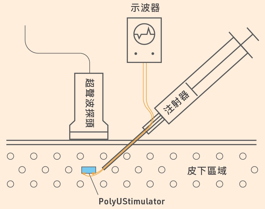 香港理工大学亦成功研发电流刺激器（PolyUStimulator）可以小至直径一毫米，细小得足以安全地以注射方法植入皮肤下。© 2024 香港理工大学