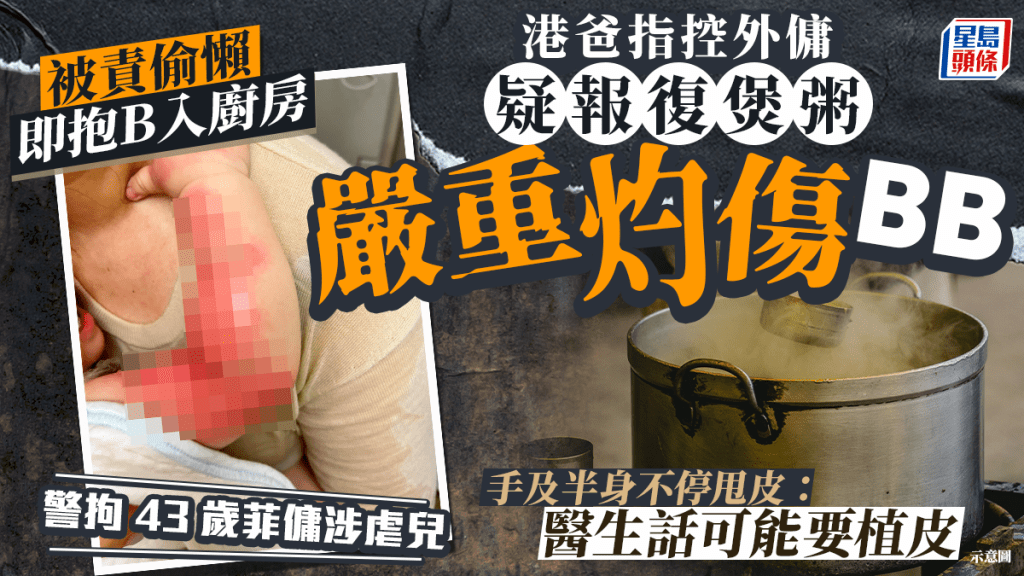 港爸指控外傭疑報復煲粥嚴重灼傷BB 手及半身不停甩皮:醫生話可能要植皮 警拘43歲菲傭涉虐兒 港爸指控外傭疑報復煲粥嚴重灼傷BB 手及半身不停甩皮:醫生話可能要植皮 警拘43歲菲傭涉虐兒