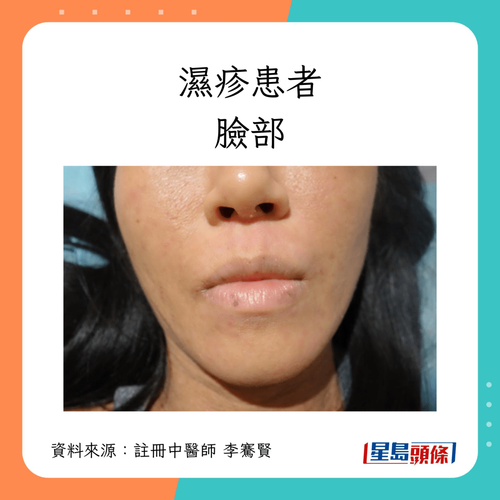 湿疹患者脸部康复过程