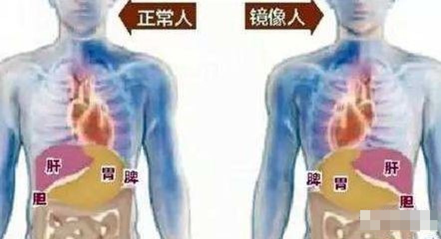 醫生發現女嬰多個內臟的位置與正常人相反,即是俗稱的「鏡面人」。網圖