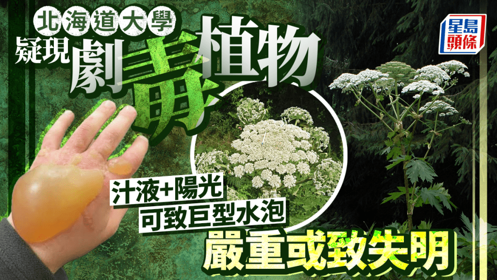 專家在社交平台上發放一張手碰到大豕草汁液後起巨大水泡的照片。