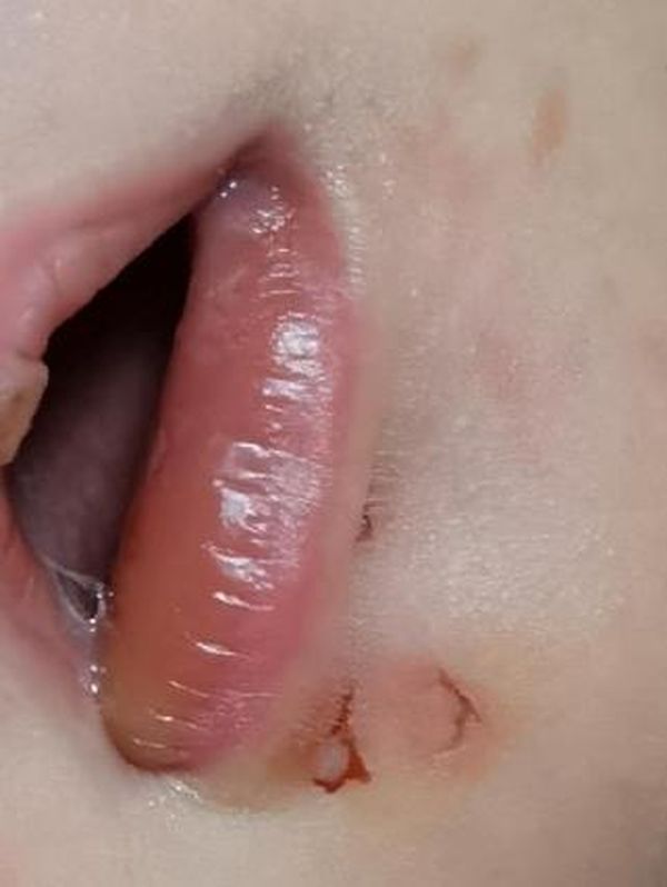 女嬰的下巴、嘴角和左手的手指均有傷口。