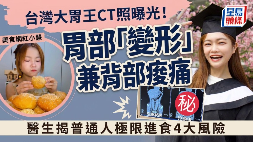 台湾大胃王CT照曝光！胃部「变形」兼背部酸痛 医生揭普通人极限进食4大风险