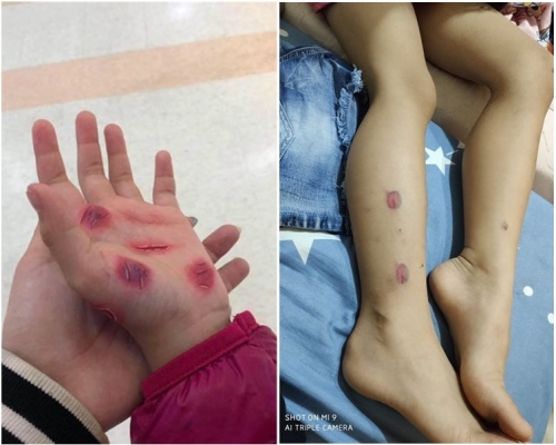 台灣一名5歲女童腿及手上出現自己畫的「傷口」。網上圖片