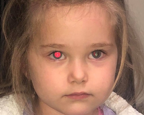 澳洲一位母親開閃光燈替4歲女兒拍照，發現其右眼出現「紅眼」，但左眼卻沒有這種狀況。　網上圖片