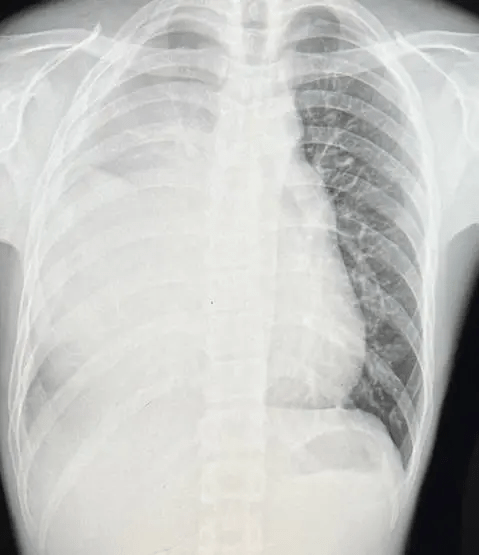 x光顯示肺部已白了一片。（圖片來源：Dcard討論區）