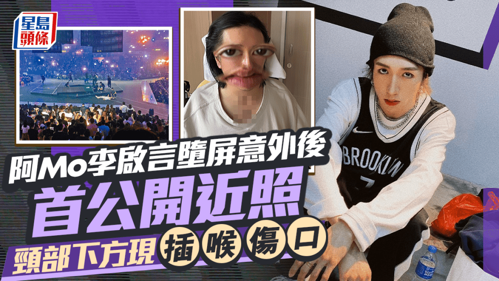 阿Mo李啟言MIRROR演唱會墮屏意外後首公開近照 頸部下方現插喉傷口