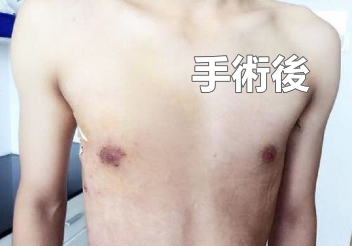 切除右邊乳房後，小楊的胸部終於恢復了原本應有的平坦。網圖