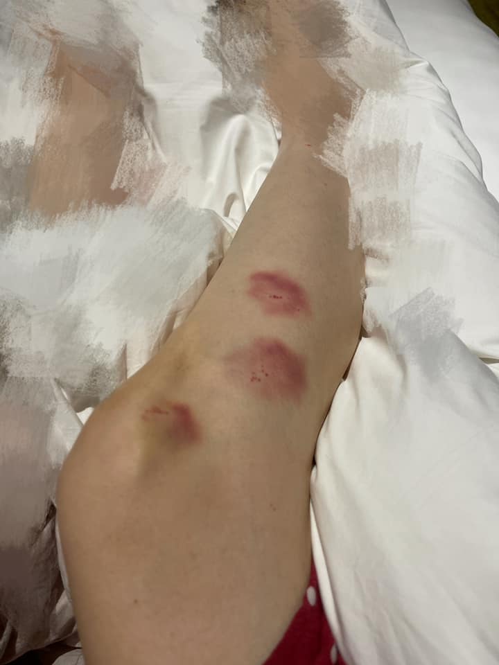 扭親膝頭哥又撞親腳。