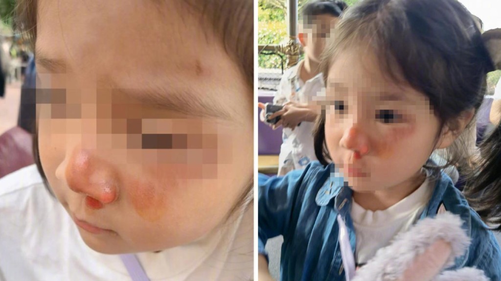 5歲女童在上海迪士尼排隊被插隊黃牛撞飛，造成臉部大面積挫傷。網圖
