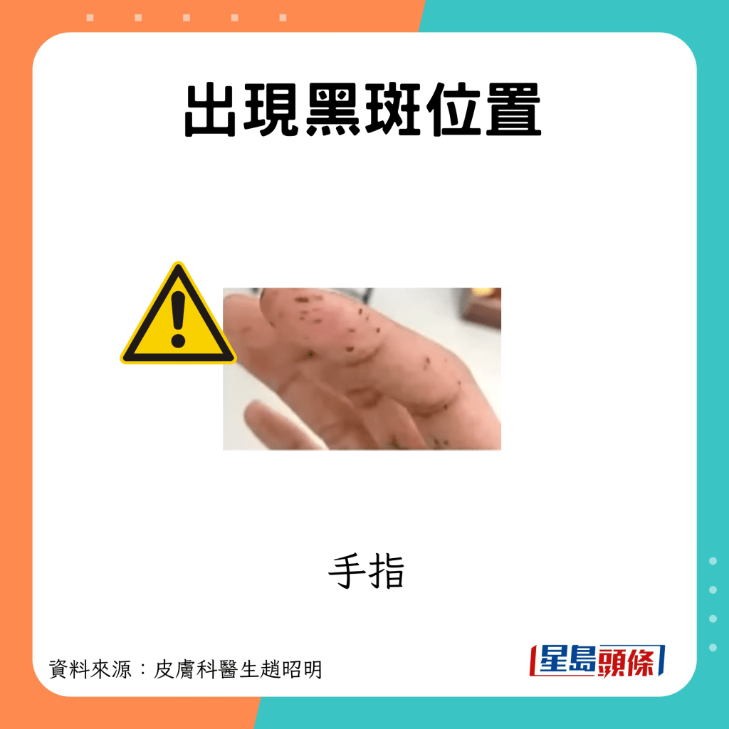 大肠癌症状｜黑斑息肉症候群：手指长出黑斑