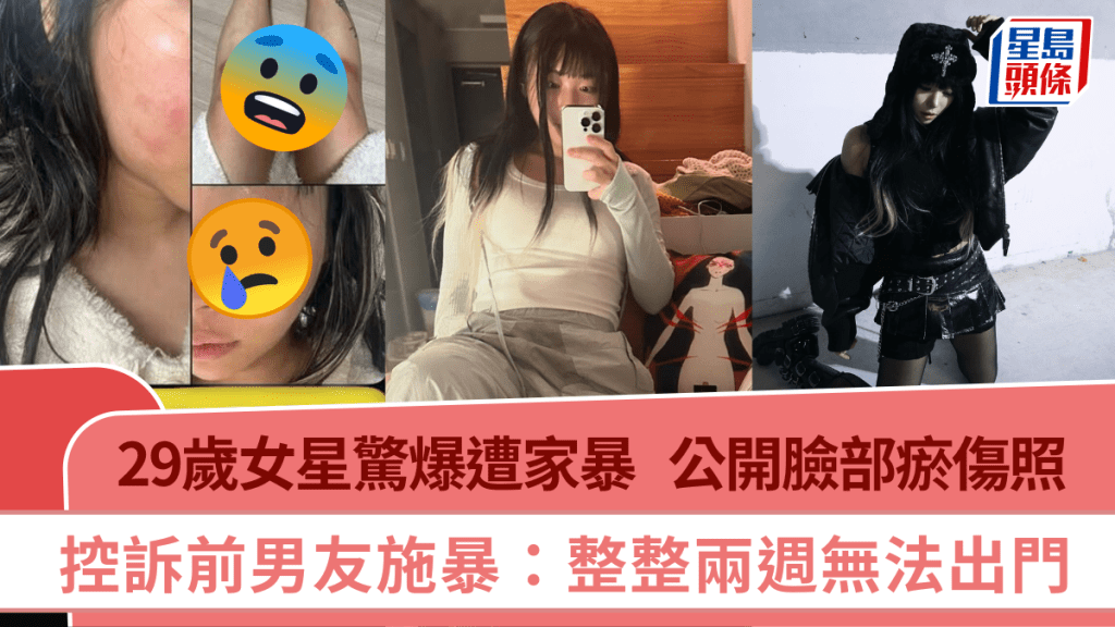 29歲女星驚爆遭家暴！公開臉部瘀傷照  控訴前男友施暴：整整兩週無法出門