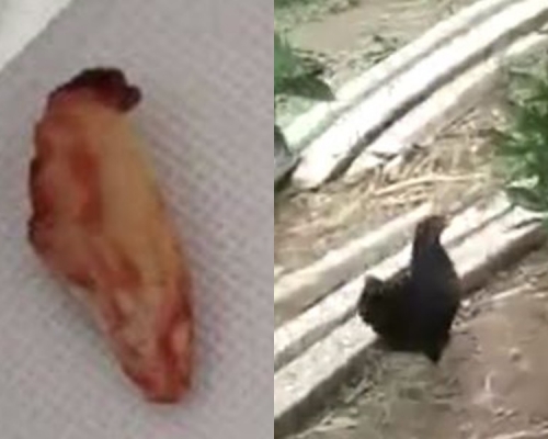 三歲男童被雞抓傷，趾甲插皮膚半月潰爛。網上圖片