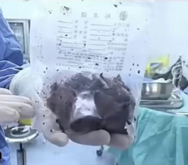 开刀取出捣碎的番薯。 开刀取出捣碎的番薯。