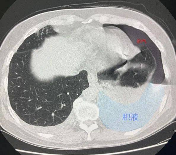 胸腔裡有大量的氣體和液體。網圖