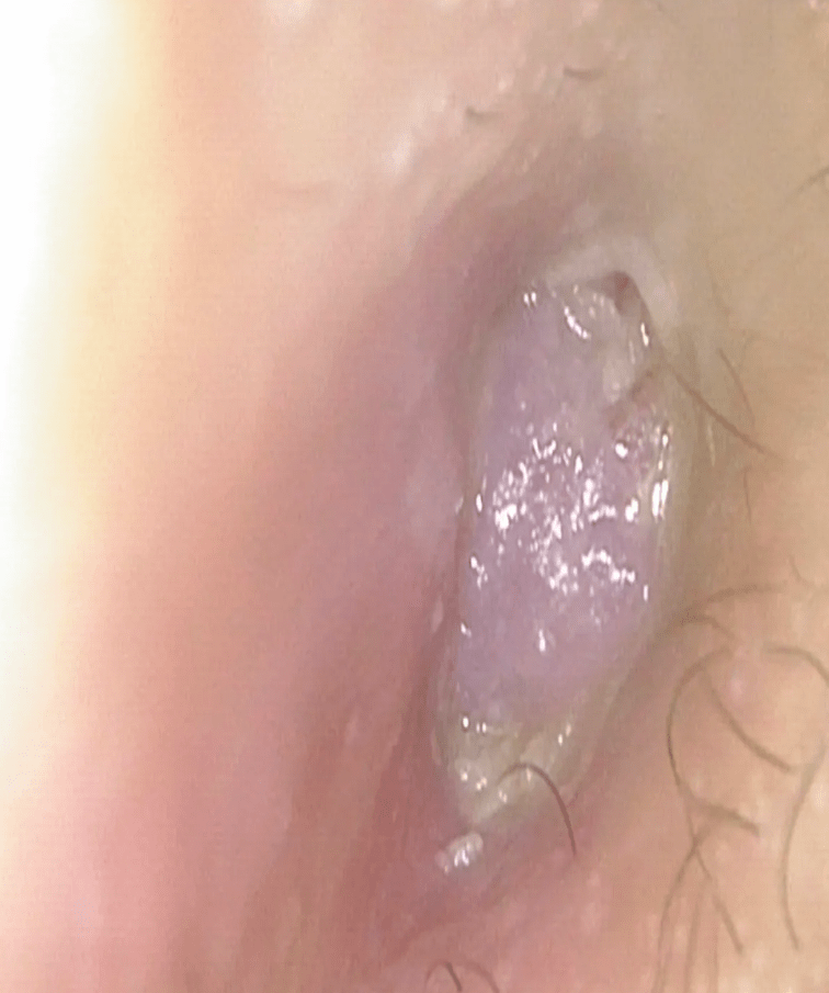 患者外耳道充滿粉紅色肉芽組織。